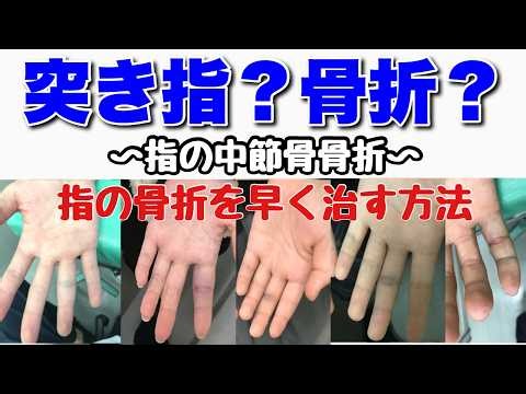 【突き指と骨折の見分け方】手指の骨折を早く治す方法〜症例比較（手の中節骨骨折）〜