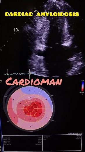 cardiac amyloidosis 🫀#echocardiography