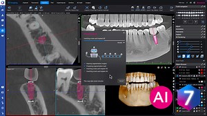 How to – Plan implants using Smart Implant tool in Planmeca Romexis