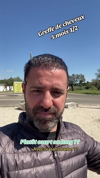 Greffe de cheveux : Évolution et choix de style