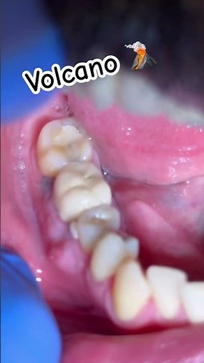 Gum Boil .. Root canal or extraction ?