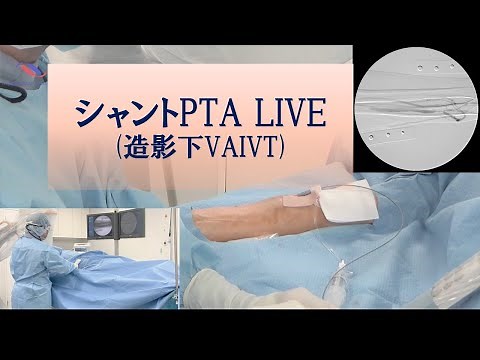 シャントPTA LIVE (vascular access intervention therapy for arteriovenous fistula, nojima2022)
