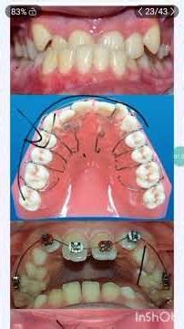 Anterior cross bite | orthodontics #dental #like #share #subscribe #likeforlikes