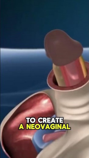 Male to Female Surgery in 3D Animation | Real Gender Transition Process #female #surgery #surgical