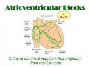 Atrioventricular Block | AV blocks made easy | AV block ECG interpretation | Types of AV Block