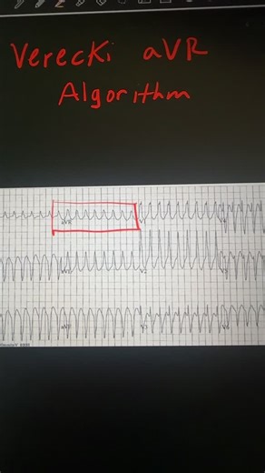 Maureen Knechtel DMSc, PA-C on Instagram: "Lead aVR alone can be very helpful for identifying VT vs SVT with aberrancy, especially when you need a quick decision. This is the Vereckei aVR algorithm 🤩 Looking only at aVR, VT is strongly suggested if any of the following are present: ❤️Initial positive R wave in aVR ~98% specific Basically says: ventricular activation is moving toward aVR → not normal. ❤️Notching on the descending limb of a predominantly negative QRS ~95% specific Reflects slow, 