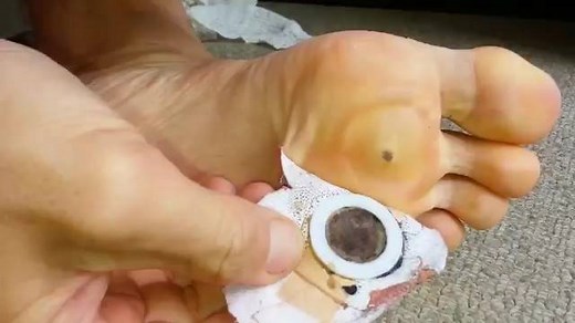 Best way to get rid of verruca. | Pimple Popping, Cyst and Blackhead