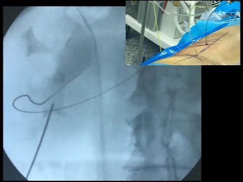 PCNL Access with Fluoroscopy Triangulation Technique