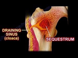Pathology 825 f Pyogenic Osteomyelitis Pathogenesis Gross Involucrum Brodie's abscess