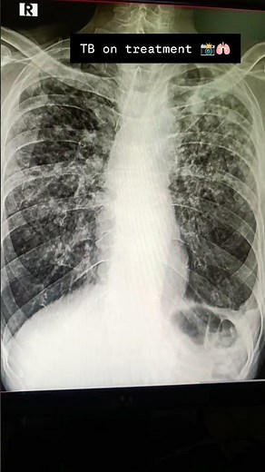 🩻TUBERCULOSIS ON Chest X-ray#trendingshorts #medicalimagingytshorts #radiology #tbc