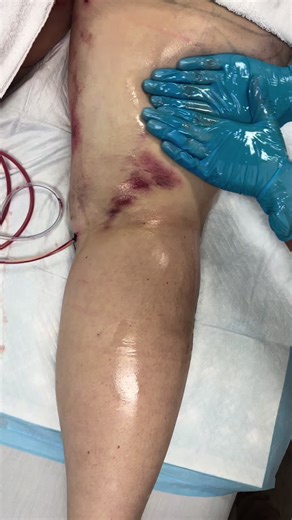 Sunday Post-Op Progress Excellent recovery progress following Inner Thigh Plastic Surgery. Our client is showing visible improvement thanks to a personalized post-operative care plan, including lymphatic drainage therapy, tissue management, and continuous clinical follow-up. At Bambu | Post-Op Care, we specialize in supporting your healing process with medical-grade post-surgical care, focused on reducing swelling, improving circulation, enhancing results, and helping you recover safely and conf