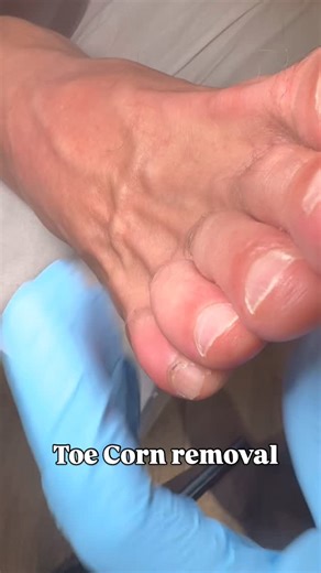 Watch this painful corn disappear 👀🌟 #podiatry #corn #cornremoval #corntreatment | Perfect Podiatry
