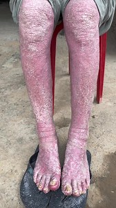 Vẩy nến của chú đây đã tan xuống đẹp, muốn tan sạch đẹp hẳn cần phải kiên trì uống và ngâm nước lá nhà cô Tuyến một thời gian nữa nha các bác #vaynen #ViêmDaCơĐịa | Hoàng Thị Tuyến