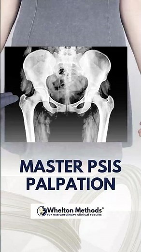 PSIS Palpation Made Simple – Clinician’s Guide