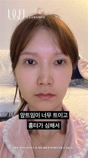 WJ원진성형외과 on Instagram: "울퉁불퉁한 쌍꺼풀, 과한앞트임흉터 #앞트임복원 #눈재수술 #셀피 #전후 ⠀ 더 많은 #성형전후 궁금하다면 @wonjin_official #팔로우 하기 ⠀ *해당 전후사진은 본원에서 직접 진료받은 환자의 동의하, 게재되었으며 개인에 따라 수술경과가 달라질 수 있습니다. ⠀ 수술 후 개인에 따라 부기, 멍, 염증, 출혈 등이 있을 수 있으므로 의료진과의 충분한 상담이 필요합니다_WJ원진성형외과💕 ⠀ 의료광고 심의필 제240328-중-166968호 본 심의필의 효력은 본 페이지에 국한됨 ⠀ 💚홈페이지 https://vo.la/zWJiN 💚카카오톡 @원진성형 💚오시는길 강남역 10번출구 파고다타워 17F"