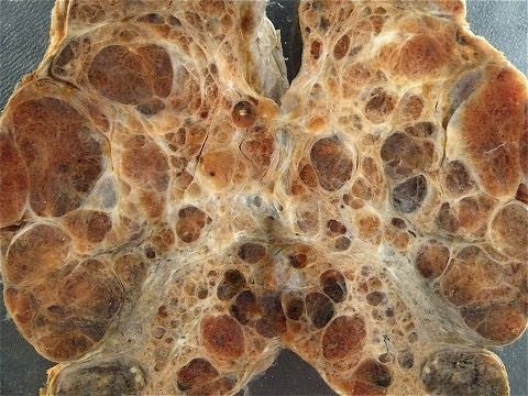 Simple and Multinodular Colloid Goitres - Pathology mini tutorial