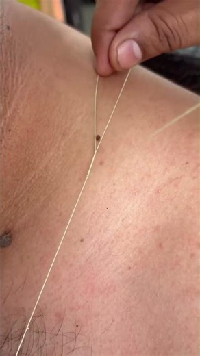 Satisfying Skin Tag Removal with Threading | Extreme Close-Up ASMR#SkinTagRemoval #Threading #ASMR