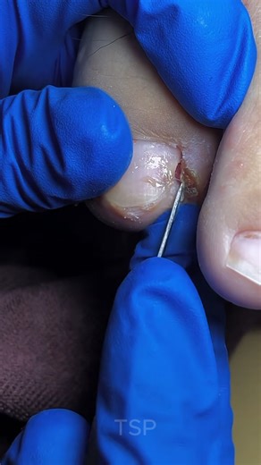 9.1K views · 52 reactions | Broken toenails, perfectly restored 﫧 #toenailcare | Pictures of Art | Facebook