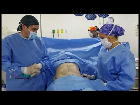Cirugía Abdominal: Abdominoplastia con Lipoescultura