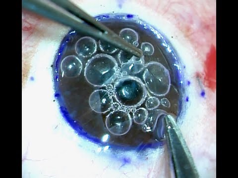 DALK for macular corneal dystrophy- surgeon's guide to central DM baring technique