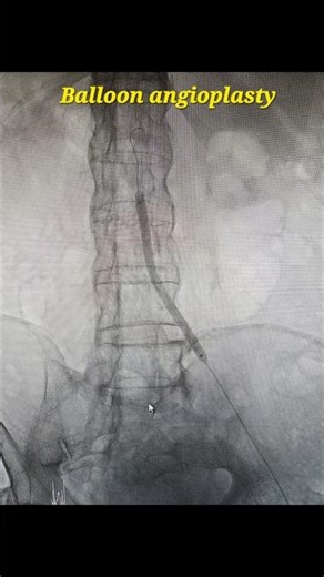 Left common iliac artery angioplasty and stenting for peripheral arterial disease (PAD)