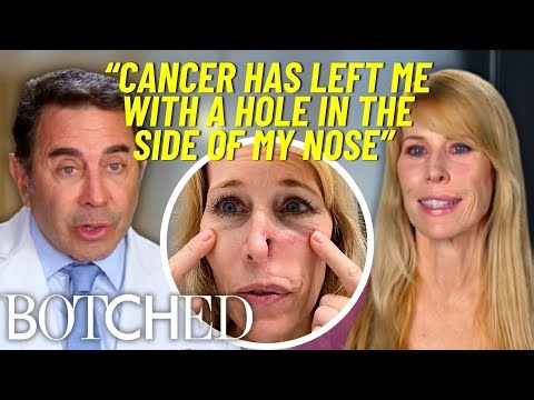 Shelley's Skin Cancer Left A MASSIVE Hole In Her Nose (Before & After) | Botched | E!