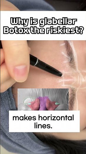 Glabella Botox (11 Lines): Procerus vs Corrugator