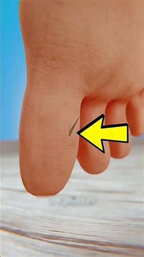 How to Remove a Splinter Without Pain (Easy Method)