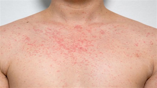 I'm a dermatologist - 3 skin rashes that show creatures are living on your skin
