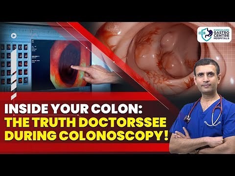 Inside Your Colon: Real Colonoscopy Findings—Polyps, Inflammation & Cancer Red Flags Explained