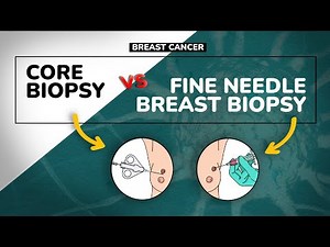 BREAST BIOPSY | Core VS Fine needle | Best breast cancer diagnosis.