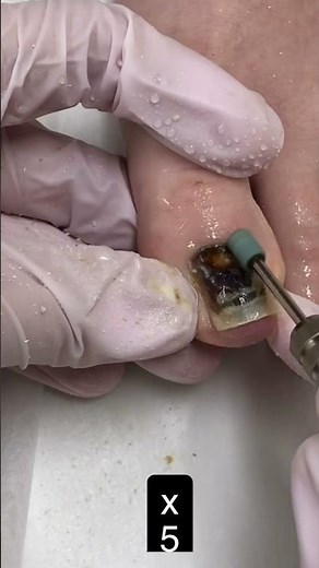 Subungual Hematoma Treatment Video