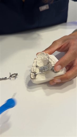 These are devices used to widen the upper or lower jaw in children twelve or younger. The AAO recommends that all children should have an orthodontic evaluation by the age of six or seven. Early intervention can prevent more serious orthodontic or surgical problems later. Expanders are used to correct narrow arches, create space for crowded or impacted teeth and even improve breathing and airway function. How expanders work: The top expanser gradually pushes the two halves of the upper jaw apart