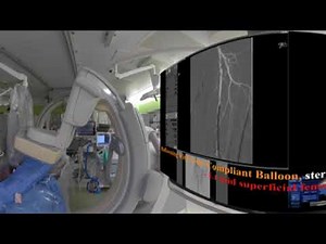 Jetstream Atherectomy under IVUS AVVIGO+ Guide(ver.2)
