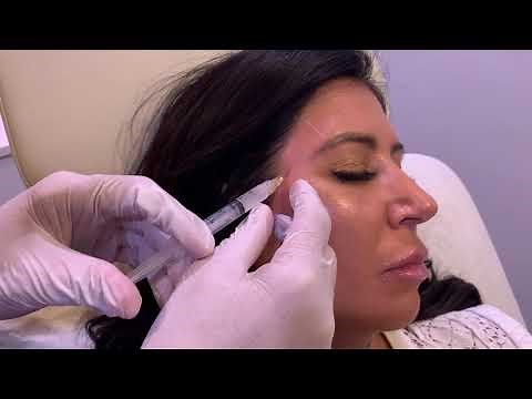 Sculptra To Fix Hollow Temples | Facial Contouring | Los Angeles