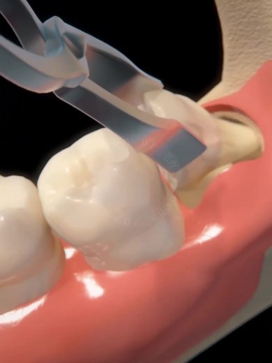 Wisdom teeth extraction #fyp #3danimation #meditok