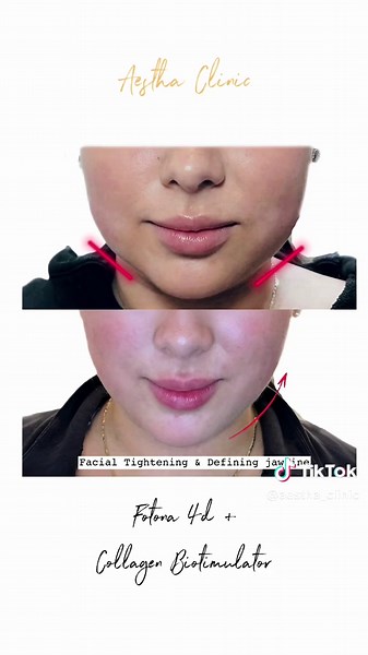 Beneficios del Láser Intraoral Fotona 4D