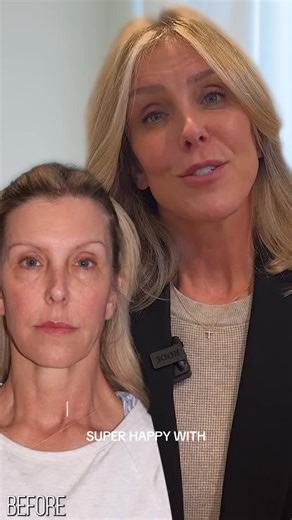 Our stunning patient, 6 months out from a facelift, brow lift, lip lift, lower blepharoplasty, fat injections and CO2 laser resurfacing on the face, neck and chest. Dr. Jerry O’Daniel, Louisville, KY ⭐️ Double Board Certified Plastic Surgeon ⭐️ Board Certified in Otolaryngology, Head and Neck Surgery O’Daniel Studios 502-584-1109 132 Chenoweth Lane, Louisville, KY 40207 #deepplanefacelift #plasticsurgery #facelift #louisvilleky #beforeandafter #blepharoplasty #fatinjections #browlift #liplift | 