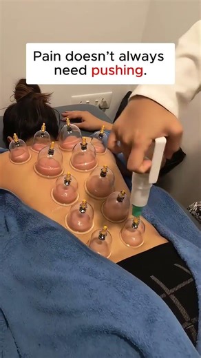 Cupping Therapy Is NOT What You Think… Here’s the Real Science