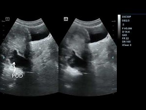 Pelvic Inflammatory Disease (PID) | Ultrasound
