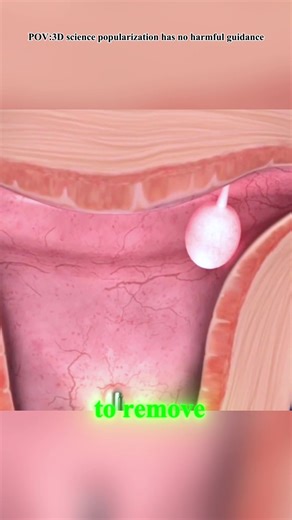 Hysteroscopy Procedure (3D Animation) #hysteroscopy #hysteroscopysurgery #hysteroscopyprocess #hysteroscopypolypectomy #hysteroscope