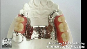 24 reactions | Cast Partial Denture. The best option for replacing...