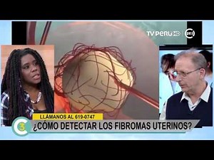 A la Cuenta de 3 - ¿Cómo detectar los fibromas uterinos? - 19/07/2017