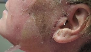 Peeling Skin from 30% TCA peel