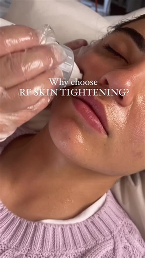 RF skin tightening is a non-invasive, painless procedure that uses radiofrequency energy to stimulate collagen production deep within your skin. Collagen, the protein responsible for maintaining the elasticity and firmness of your skin, naturally decreases as we age. But with RF skin tightening, we can reverse the signs of aging and restore your skin’s natural beauty. Why choose RF skin tightening? Unlike other procedures that require surgeries or injections, RF skin tightening is a safe and eff