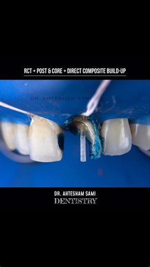 TeethTuber on Instagram: "Transforming decay into a masterpiece! ✨ RCT followed by post & core and direct composite build-up on a severely decayed maxillary central incisor. Restoring function and beauty! 🦷💖 #RestorativeDentistry #SmileMakeover #dentalartistry"