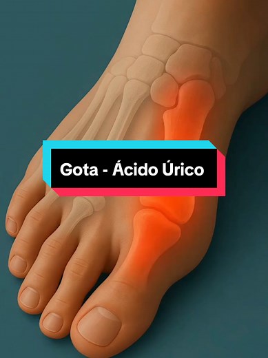 Gota: Causas e Sintomas da Doença