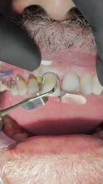Anterior teeth composite veneer after removal of caries ,the patient was so happy with the new smile