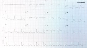 Brugada Syndrome