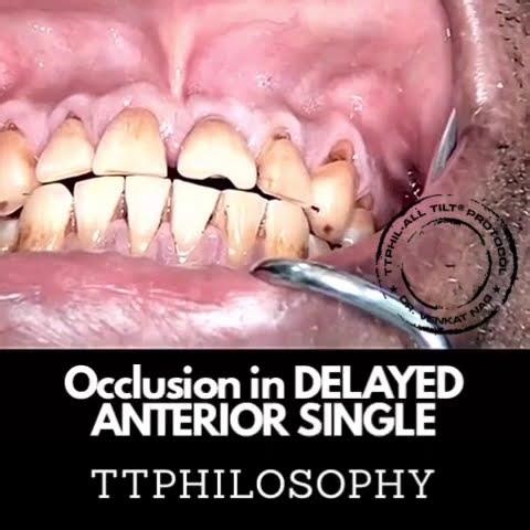 Anterior Implant Occlusion in TTPHIL | Delayed Single Tooth Case Explained